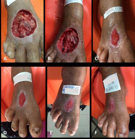 of haemoglobin spray); Diagnosis: Wound on the palmar and dorsal surfaces of the right hand with amputation of the fifth finger subsequent to drainage, surgical debridement and amputation caused by