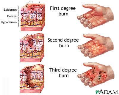 Severity of Burns First-degree burns Only epidermis is damaged Skin is red and swollen Second degree burns Epidermis and
