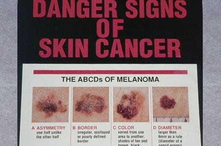 Skin Cancer Types Malignant melanoma Most deadly of skin cancers Cancer of