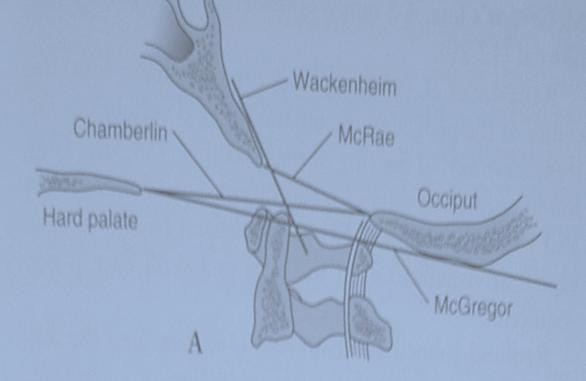 X ray: McRae s line Chamberlin s line McGregor s lines line Value of using these lines are unclear and can be difficult Ideal: MRI: Tip of the odontoid above the level of foramen magnum.