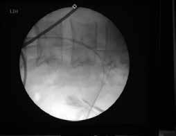 Photo 6. Fluoroscopic aspect of the two guided wire inserted through the percutaneous renal acces Subsequently, the position of the puncture needle was checked and corrected radiographically.