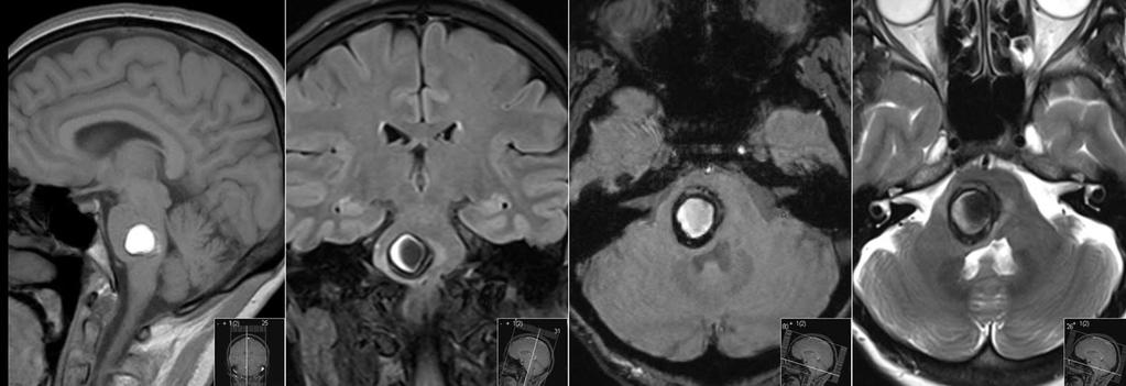 Cavernous malformations Presentation and clinical features Asymptomatic (30-50%) Seizures (60%) Focal neurological deficits (up to 50%) Headaches (25-50%) Natural history May demonstrate spontaneous
