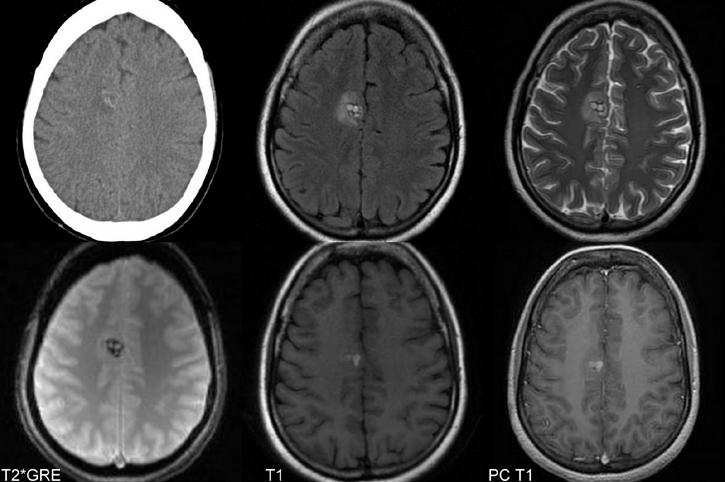 Cavernous malformations Imaging CT Could be negative in small lesions May show hyperdensity related to calcification or hemorrhage May demonstrate mild or prominent enhancement MRI Imaging study of
