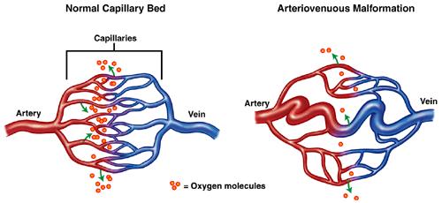 Arteriovenous malformations vs fistulas Both are abnormal connections between arteries and veins without an intervening capillary bed