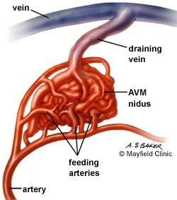 What s the difference between an AV malformation and AV fistula?