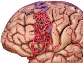 Arteriovenous malformations Histopathology Arteries Abnormally dilated Degenerative changes due to high flow Prone to aneurysm formation There may be single or multiple feeding arteries Nidus Vessels