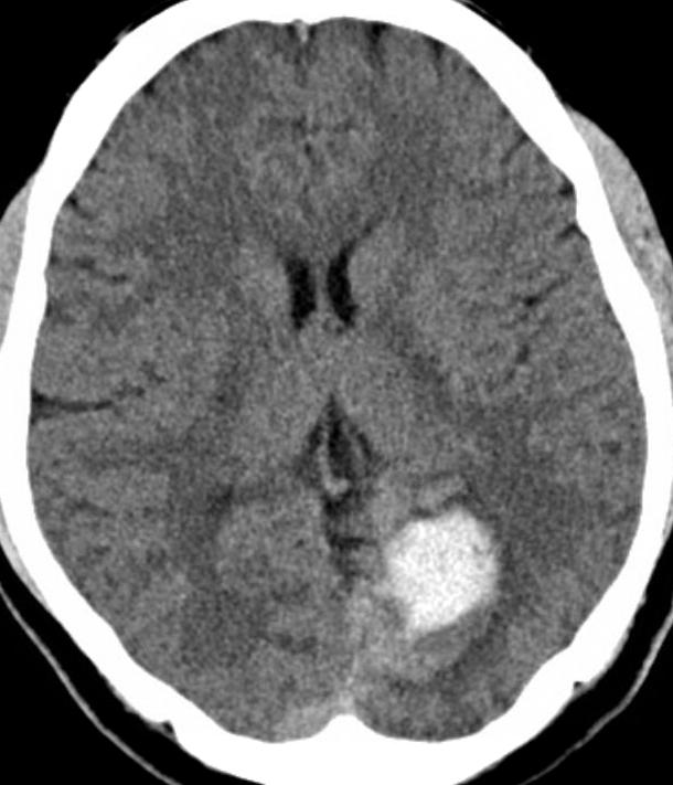 Arteriovenous malformations Peak age for hemorrhage:15-20 yrs With each bleed: Mortality: 10% (5-30%) Morbidity: 20-30% Risk factors for hemorrhage Prior hemorrhage