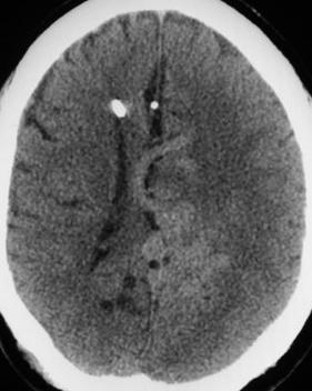 CT Arteriovenous malformations Imaging Non contrast CT MRI Will show acute hemorrhage May be negative for small,