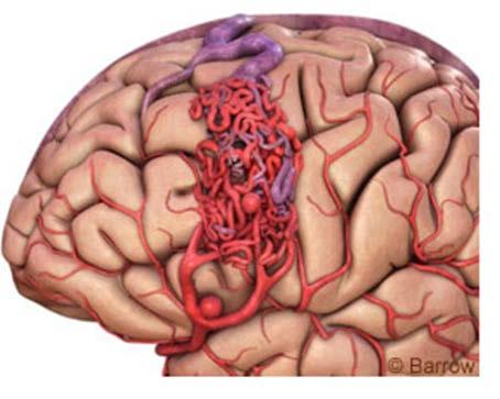 Cerebrovascular Malformations Primarily congenital lesions of cerebral vessels 0.