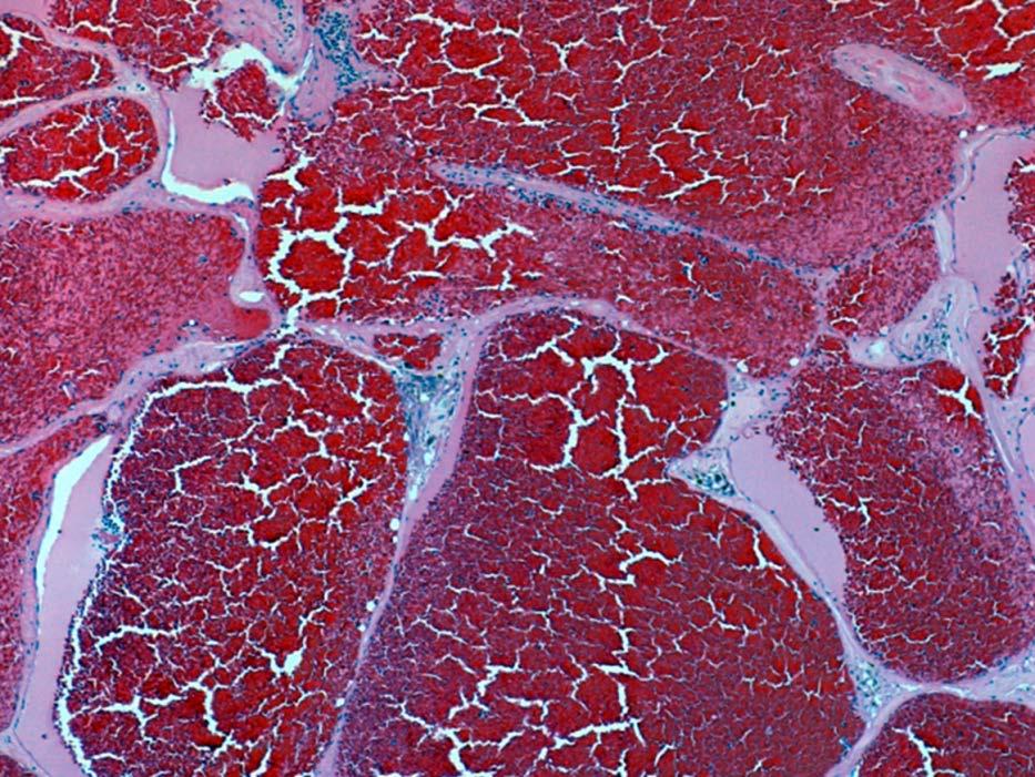 Histopathology Arteriovenous malformations (AVMs) Arterial nidus (nest) Draining vein No intervening capillary bed Venous angiomas (DVA) Dilated WM veins Normal intervening brain