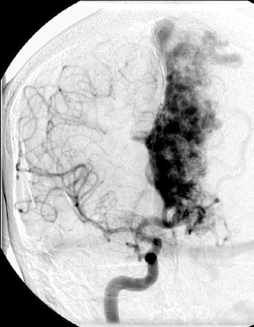 Arteriovenous malformations