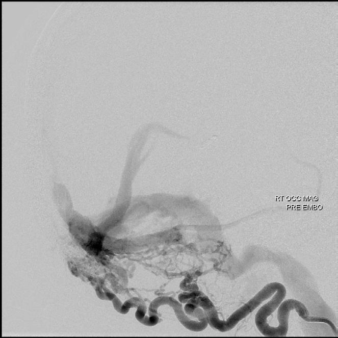Arteriovenous fistula Angiogram Multiple bilateral feeders Occluded R transverse-sigmoid Retrograde filling of