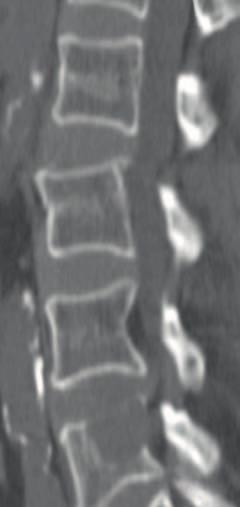 CT DWI DWI Lung tumor and metastatic lesion Patient with lumbar pain and left radicular pain. CT of the lumbar spine shows an osteolytic lesion in the lumbar body L4 (rectangle).