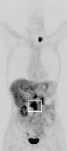 PET CT DWI Suspected neuro-endocrine tumor Patient presenting with increased chromogranine tumor marker, suspect of