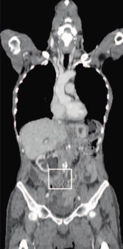 DOTATOC PET and co-registered CT show a metastatic lesion in the left thoracic inlet (arrow) and a tumoral mass in the