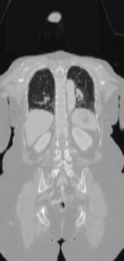 FDG-PET CT DWI With MultiTransmit, the anatomical sequences have really shortened, reducing their imaging time tremendously.