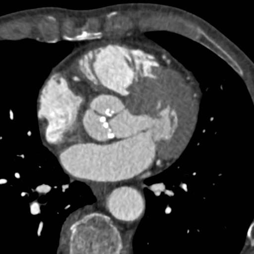 Valvular Assessment CT No means of quantifying