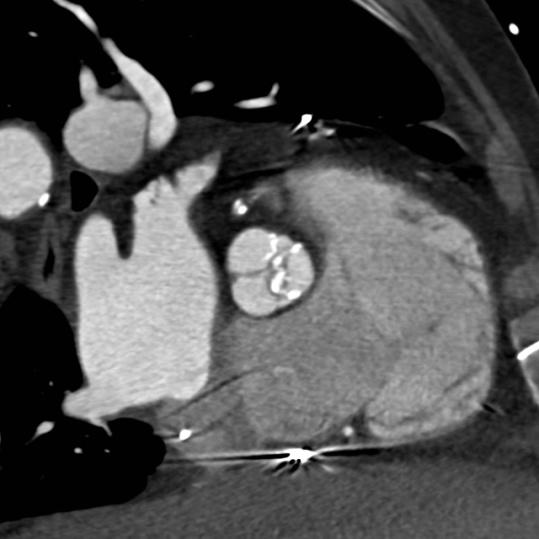 selected clinical scenarios TAVR aortic Valve