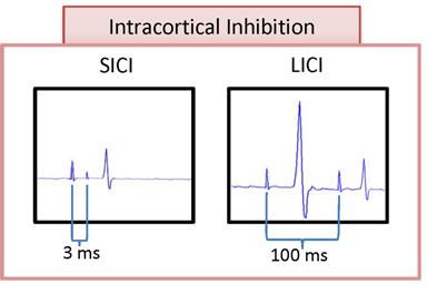 LICI (long-interval intracortical inhibition) CS suprathreshold