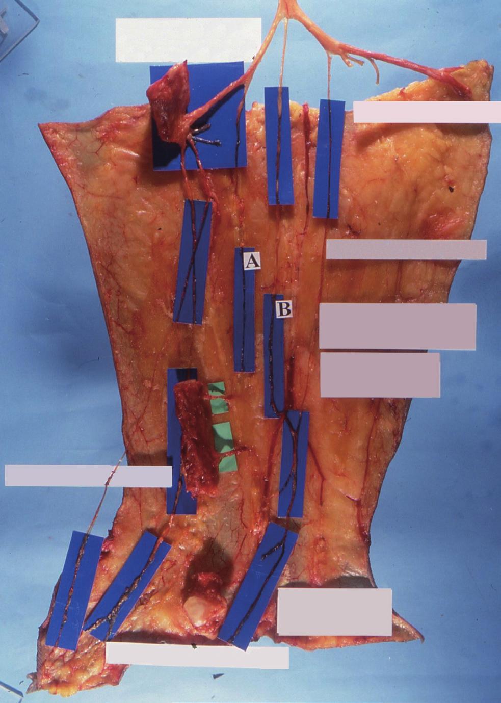Vol. 41 / No. 6 / November 2014 the subcutaneous entry point to form the common sural nerve at a mean distance of 14.5 cm (11.5 18 cm) proximal to the lateral mallelolus (Table 1).