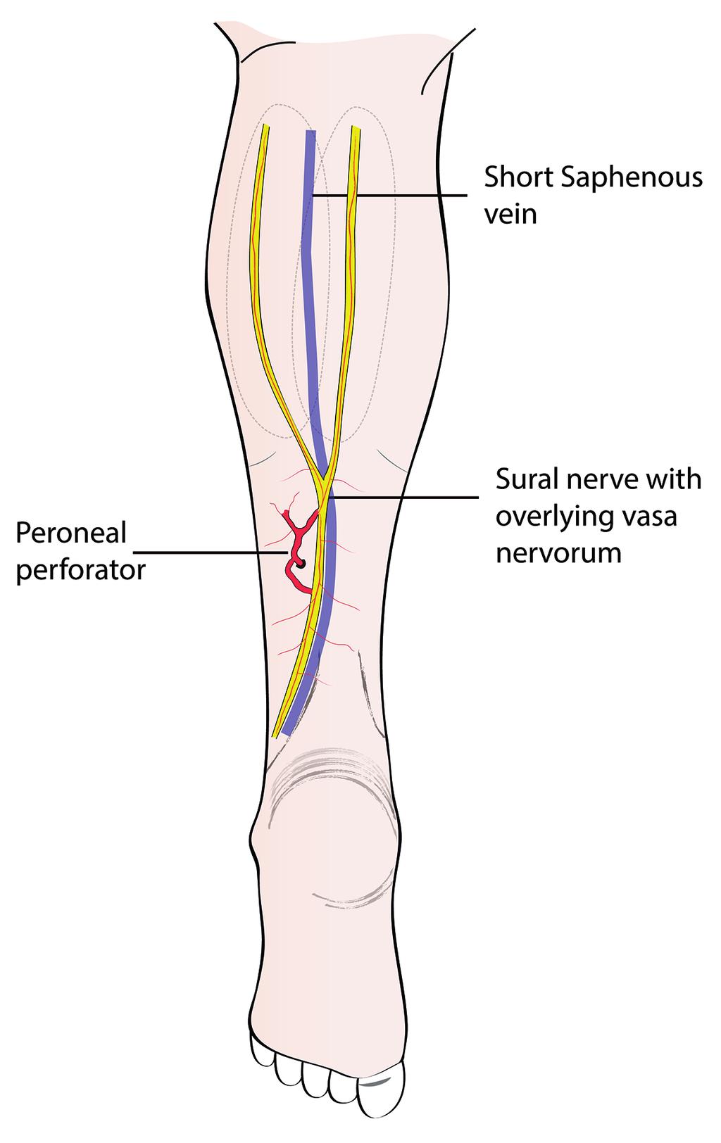 The short saphenous vein ran in the subcutaneous plane following the posterior midline of the leg and pierced the muscle fascia in the upper third of the leg to join with the popliteal vein (Fig. 3).