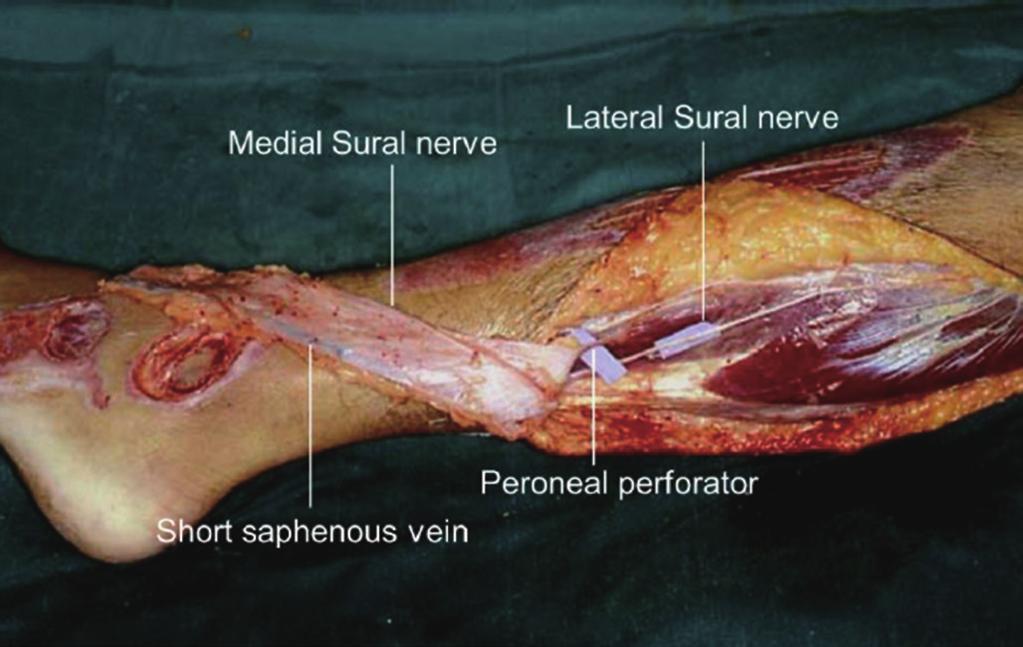 turn down adipofascial flap. The distal defects were resurfaced with split skin grafts.