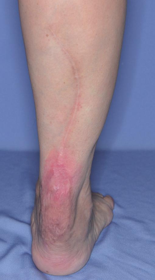 A case of tendo-achilles wound breakdown (A) Skin breakdown after tendo-achilles repair with resultant 5 cm 2 cm defect.