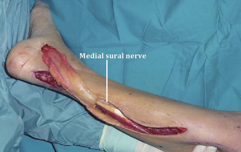 Inclusion of the sural nerve and short saphenous vein gives a robust axial blood supply to the flap [5,6].