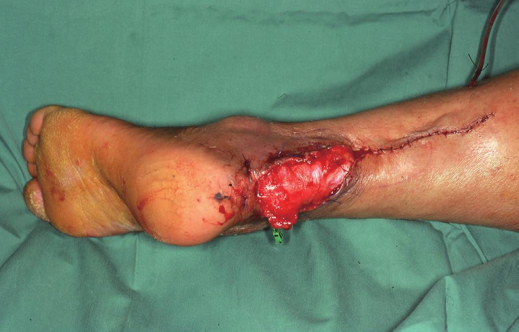 Thus, the inclusion of the sural nerve and short saphenous vein improved vascularity and permitted the harvest of a longer flap.
