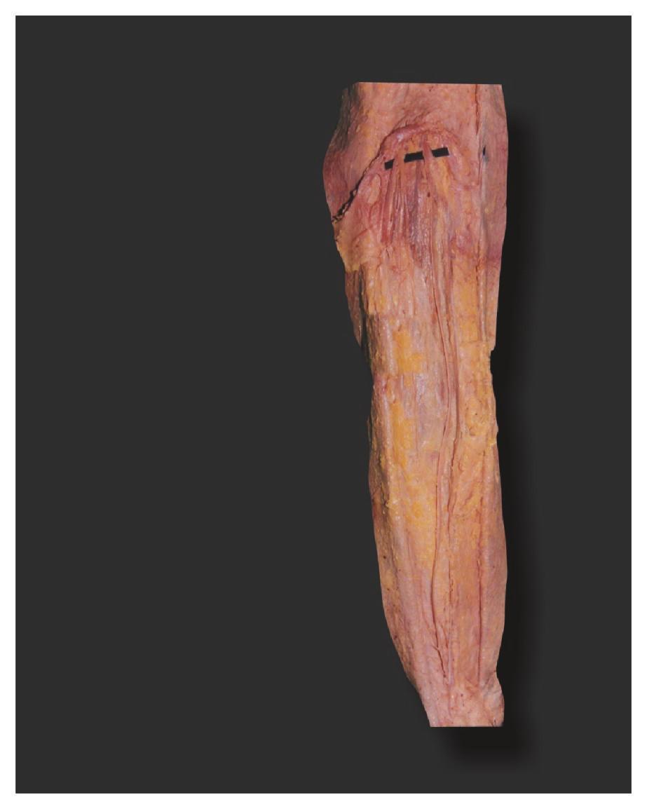 2 ISRN Anatomy Figure 1: Medial sural cutaneous nerve continuing as sural nerve (: medial sural cutaneous nerve. : lateral sural cutaneous nerve. : tibial nerve. : common peroneal nerve).