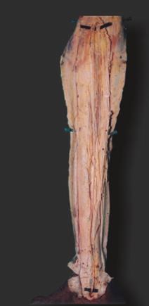 When there is a situation requiring limited length of nerve graft material, the peroneal communicating nerve alone can be harvested and medial sural cutaneous nerve can be preserved and associated