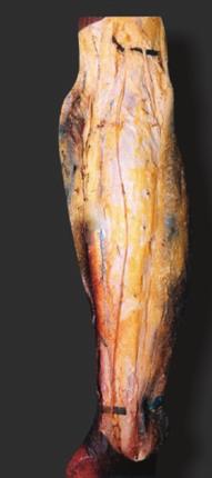 : tibial nerve. : common peroneal nerve). 2.
