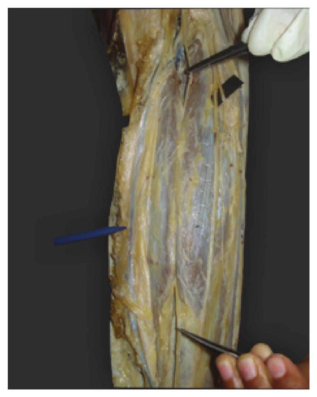 Figure 6: Peroneal communicating nerve communicated with medial sural cutaneous nerve at different levels (: medial sural cutaneous nerve. : lateral sural cutaneous nerve.