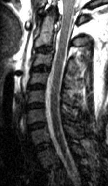 MRI for injury detection negative plain films negative CT scan but