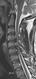 Acute traumatic disc herniation Central cord syndrome- most common Axial or flexion loading of disc Edema