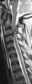 hyperintense relative to spinal cord on T2-weighted images