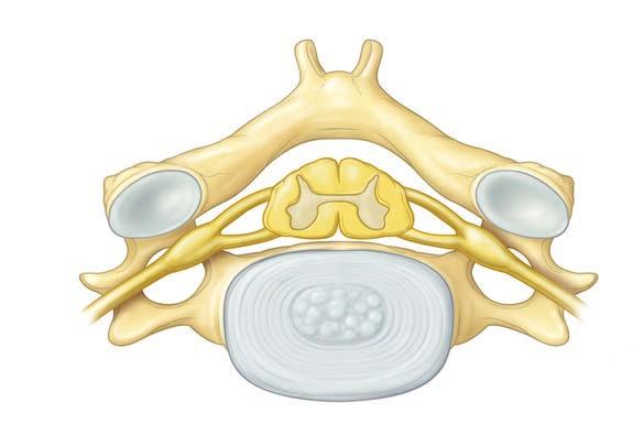 The neck is made up of the first seven vertebrae in the spine. Disks are soft pads of tissue that act as shock absorbers between the vertebrae.