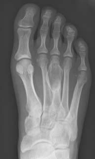Figure 2a and 2b radiographs a) pre-operatively, showing an expanding lytic lesion without cortical disruption in the metaphysis of the third metatarsal bone and b) at three months after primary