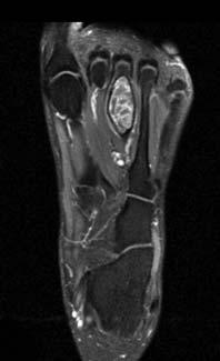 Figures 2c and 2d radiograph (c) and T 2 -weighted MR scan (d) at one year postoperatively, showing signs of local recurrence with secondary aneurysmal bone cysts.