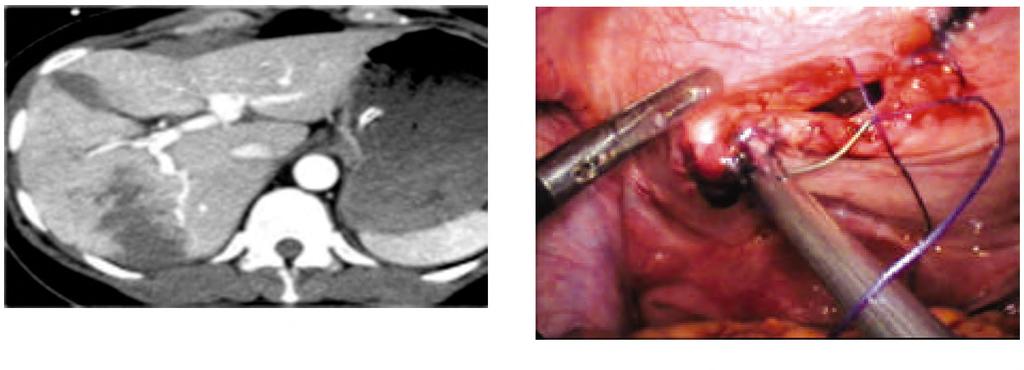 582 Conservative Versus Delayed Laparoscopic Exploration Fig. (5): CT scan of Grade IV intrahepatic hematoma with no haemoperitonium. Fig. (8): Large hepatic laceration reaching gall bladder fossa.