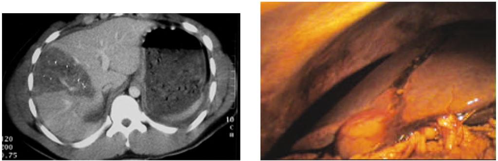 (9): Repair of the bladder tear laparoscopically. Fig.