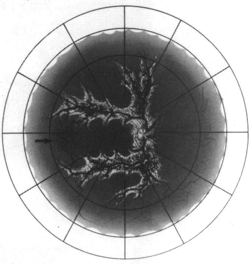 Retinal microangiopathy in pigmented paravenous chorioretinal atrophy Fig. 2 Microaneurysm and telangiectasia seen in the temporal periphery (arrow) ofthe right eye.