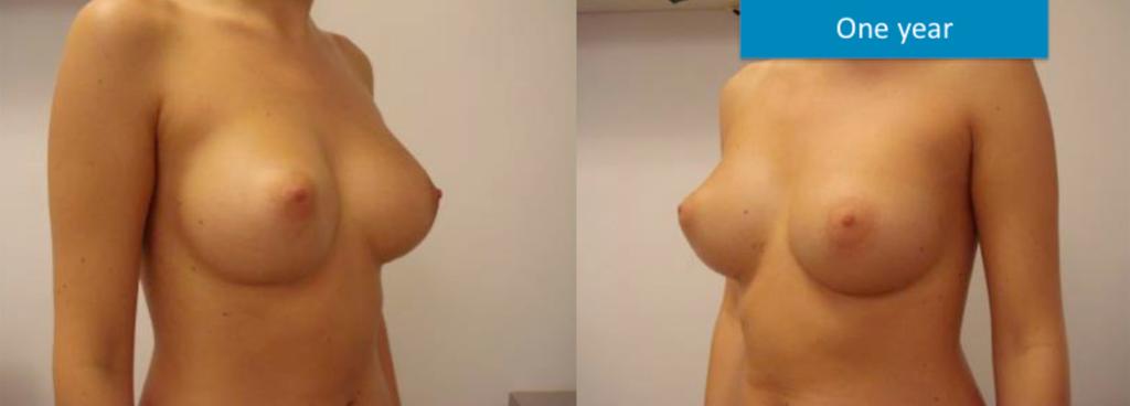 In case of augmentation mastopexy, we suggest the surgeon to consider round implants use if not completely confident with anatomical implants.