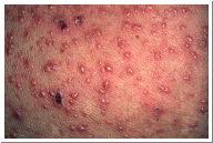 before rash until healed Supportive care Consider acyclovir >12 years old Pulm, Skin