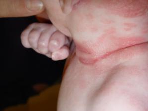 disorder Most common rash in 1st month Greasy scales; red papular dermatitis Other