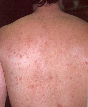 Pityriasis Rosea Probably viral in origin; 5 years old Typically on trunk, with Christmas
