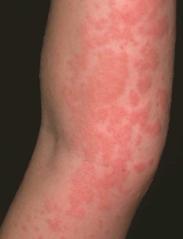 Urticaria - Treatment ABCs Try to identify etiology If severe, epi, 0.01 ml/kg SQ (0.