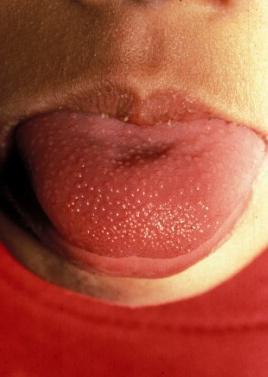Rash: generalized, desquamation Red oral pharynx; strawberry tongue Erythema/ Edema extremities Coronary