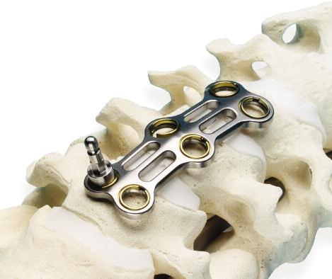 The Temporary Fixation Tack is positioned utilizing the Temporary Fixation Tack Inserter.