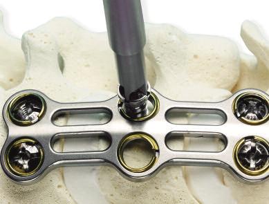 The unique open design provides excellent intra-operative visualization of the bone graft and endplates, allowing for greater postoperative